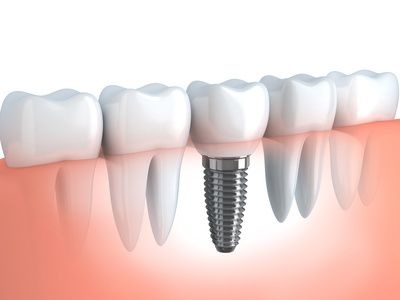 all on 4 dental implants in los algodones1 1