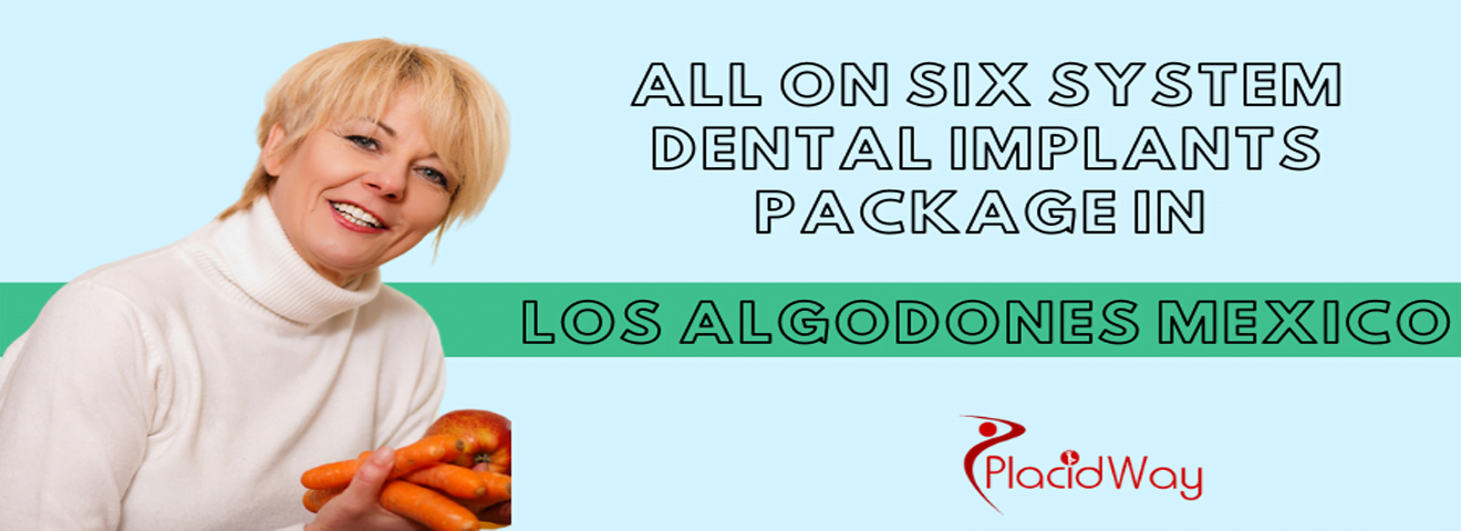 All on 6 System Dental Implants in Los Algodones