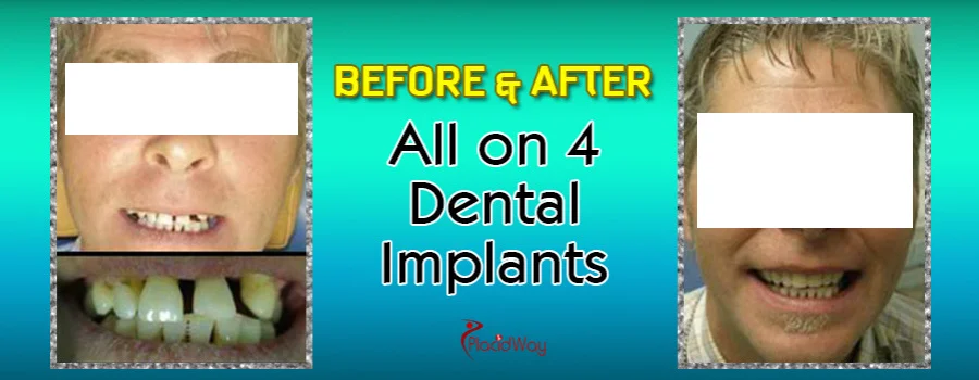 All-on-4 Dental Implant before and After