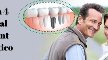 all on 4 dental implant in mexico