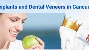 Dental Implants and Dental Veneers in Cancun Mexico