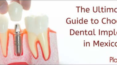 Implantes dentales en México