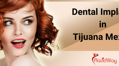 Dental implants in tijuana Mexico