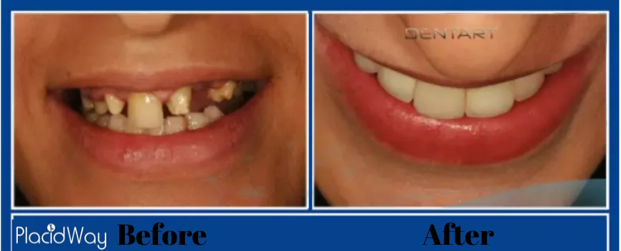 Dental Crowns Before and After in Mexicali Mexico